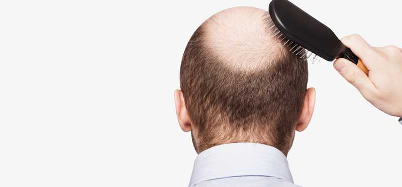 Che cosa è la perdita dei capelli DHT e come trattare?