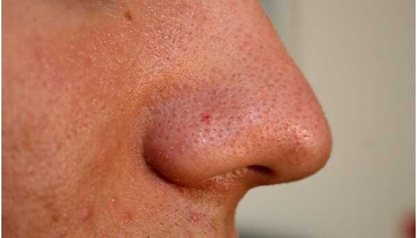11 diversi tipi di acne e come identificarli?