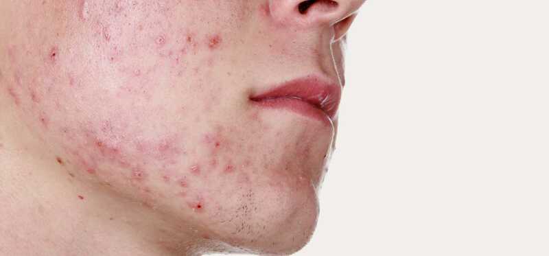 Adulti tipi di acne, cause, tensione e cura