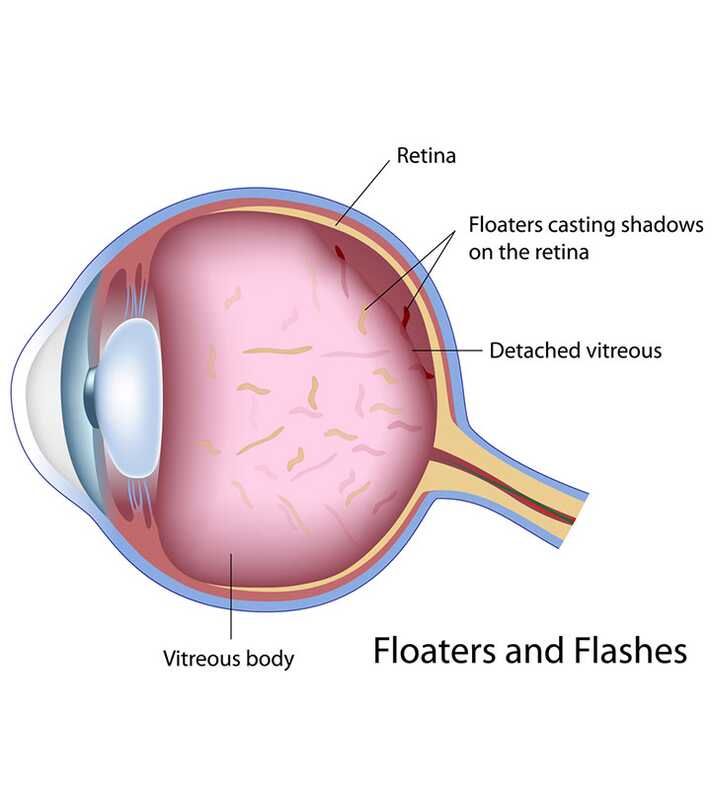 15 efficaci rimedi domestici per Floaters degli occhi