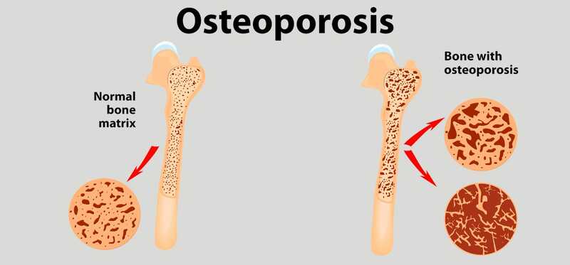 25 rimedi efficaci a casa per curare l'osteoporosi