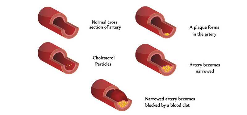 10 efficaci rimedi domestici per ridurre i livelli di colesterolo