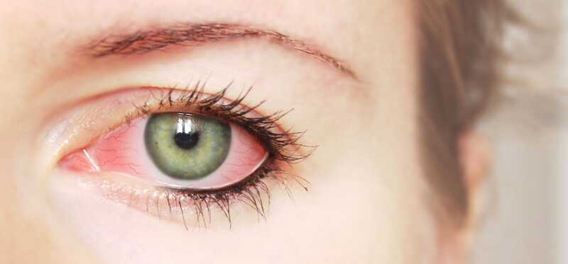 25 efficaci rimedi domestici per trattare l'infezione agli occhi