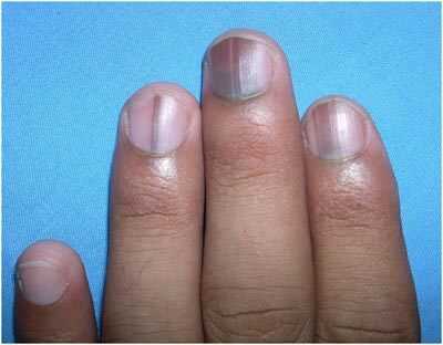 Quali sono gli effetti di Deficiencies nutrizionali sulle unghie e come risolverli?