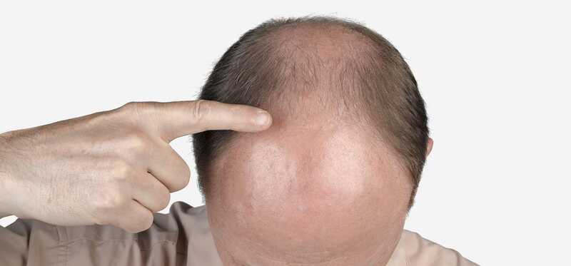 Qual è la perdita dei capelli frontali e come trattare?