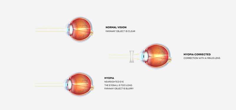 10 Rimedi domestici efficaci per Myopia