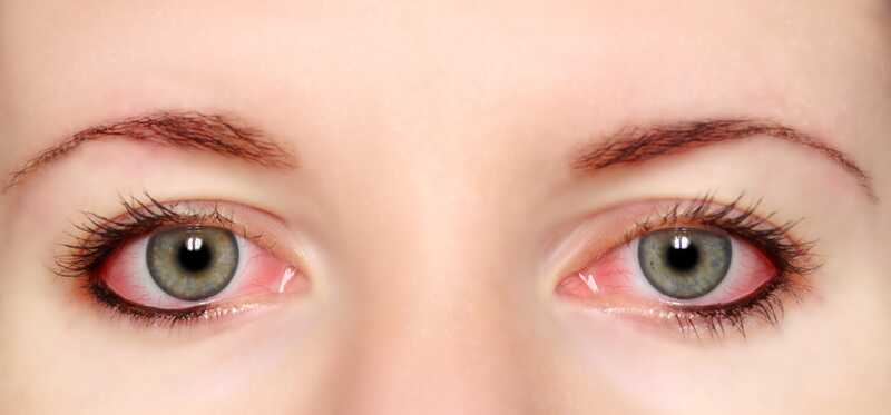 21 rimedi efficaci per gli occhi rossi