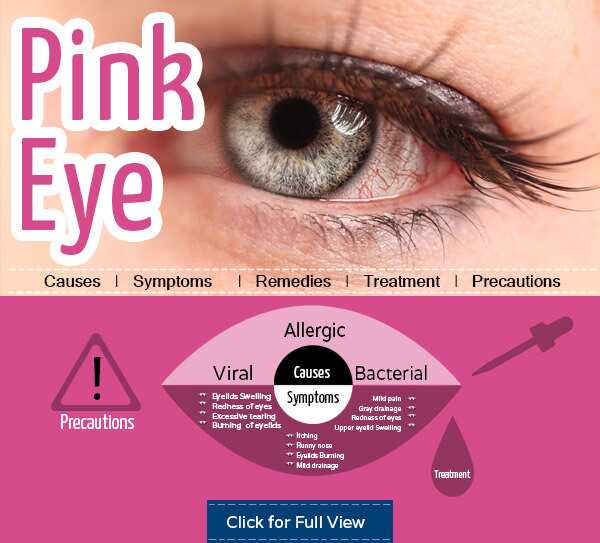 Top 10 rimedi domestici per ottenere il sollievo dall'occhio rosa