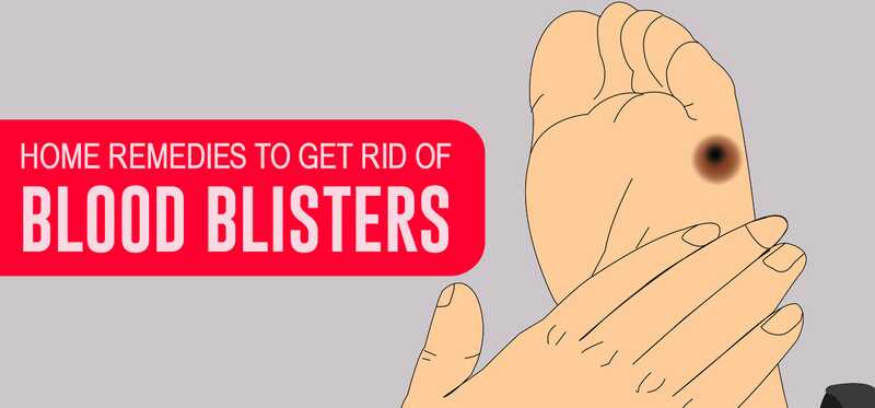10 efficaci rimedi domestici per sbarazzarsi di sangue Blister