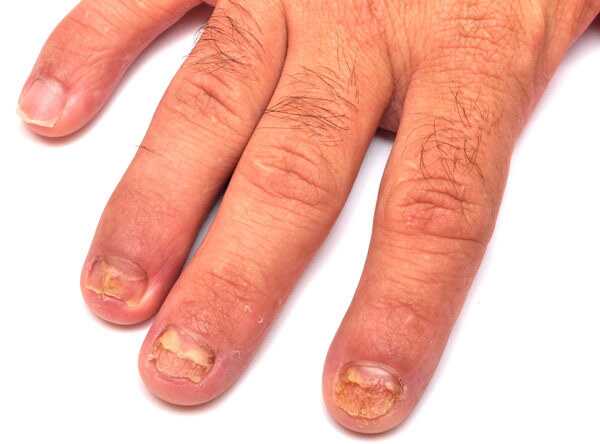 Top 36 rimedi casalinghi per il trattamento del fungo da unghie