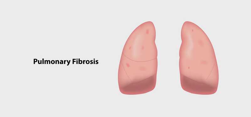 8 efficaci rimedi domestici per trattare la fibrosi polmonare