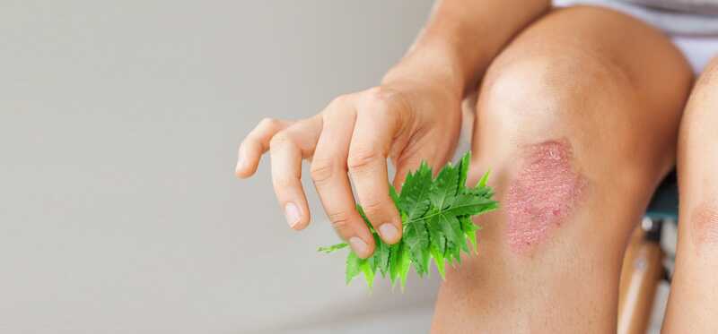 Neem è un efficace cure per eczema?
