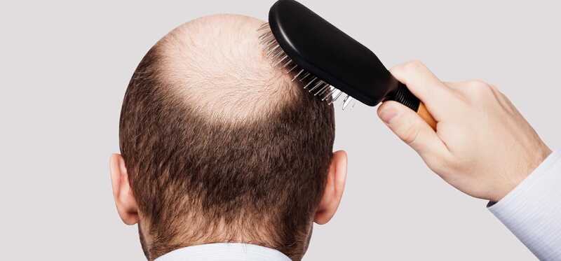 Mesoterapia per la crescita dei capelli - funziona?