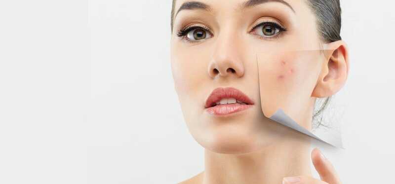 10 semplici rimedi per il trattamento della pelle secca sul viso con l'acne