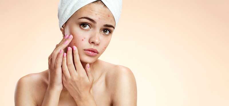 21 suggerimenti semplici per controllare l'acne in adolescenti